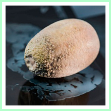 Calculous Cholecystitis