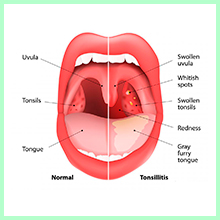 Chronic tonsillitis
