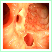 Diverticulosis