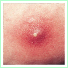 Furunculosis Furunculosis