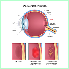 Macular degeneration