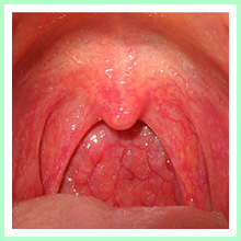 Pharyngitis