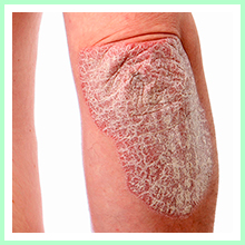 Psoriasis Psoriasis