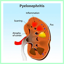 Pyelonephritis