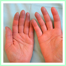 Raynaud's Disease Raynaud's Disease