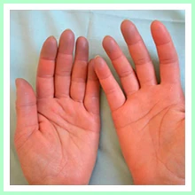Raynaud's Disease