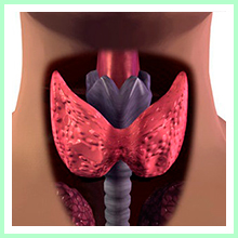 Thyroid dysfunction - Hyperthyroidism