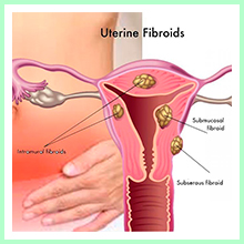 Uterine fibroids