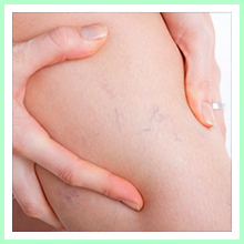 Varicose veins Varicose veins