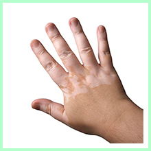 Vitiligo Vitiligo